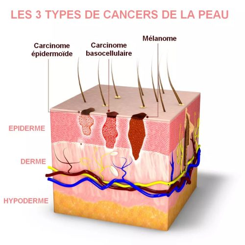 3 types de cancers de la peau